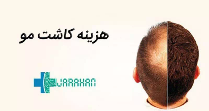 هزینه کاشت موی ترکیبی در تهران